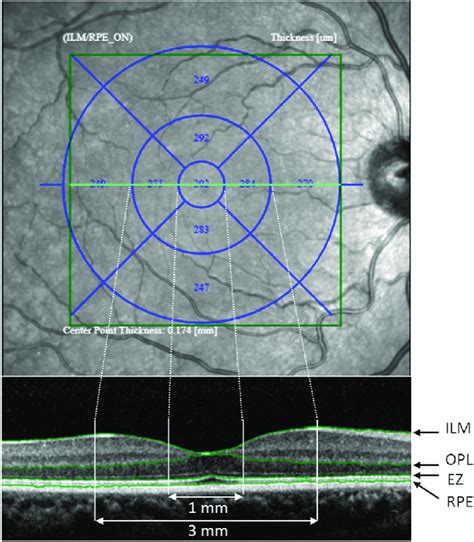 macular edema retinal thickness measurement|macular thickness calculation.